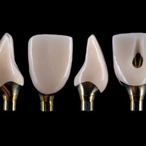 https://reliablearts.com/wp-content/uploads/2021/03/Photograph_1750991_Dr.Duka_Pt.Warkentin_9_Screw-Retained_Element-Z_Crown_with_Custom_Gold_Ti_Abutment_02-300x300.jpg
